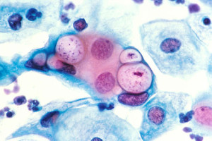 460px-Pap_smear_showing_clamydia_in_the_vacuoles_500x_H&E